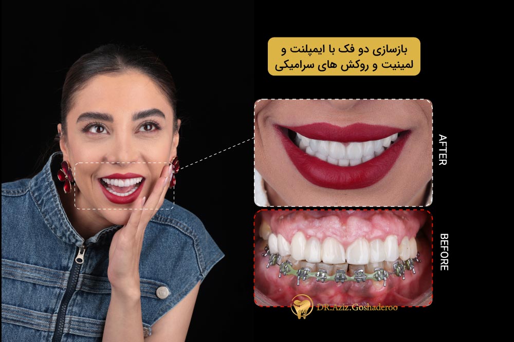 مرکز ایمپلنت دندان در تهران